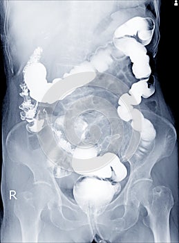 Radiological examination to look for colon abnormalities By enema the barium powder and air into the anus.