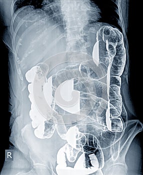 Radiological examination to look for colon abnormalities By enema the barium powder and air into the anus.