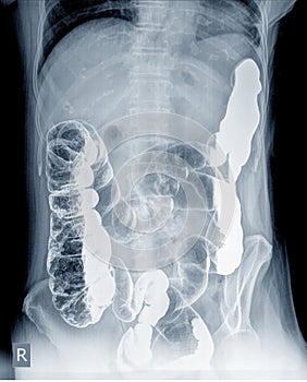 Radiological examination to look for colon abnormalities By enema the barium powder and air into the anus.