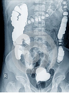 Radiological examination to look for colon abnormalities By enema the barium powder and air into the anus. photo