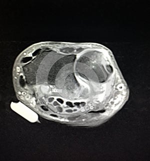 Radiological mri exam wrist anatomy pathology