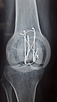 Radiological picture of surgery ball joint