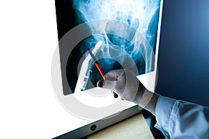 A radiologist examines an X-ray of the hip joint in close-up