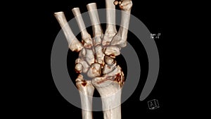Radiology examination, Computed Tomography Volume Rendering examination of the wrist joint