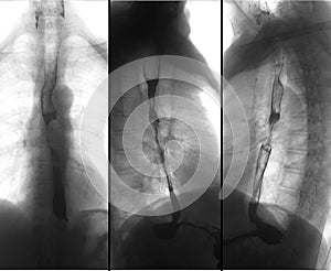 X-ray of the upper gastrointestinal series UGI with barium. Cancer of the esophagus. Negative.