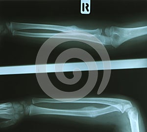 Radius Fracture