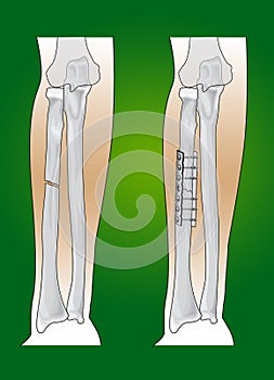 Radius fracture surgical intervention photo