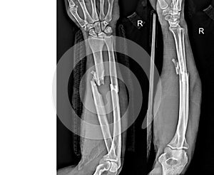 Radius Ulna Radiograph showing Fractures