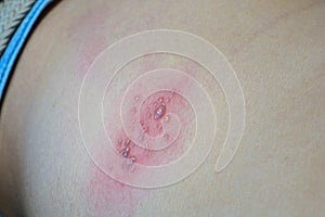 Blisters caused by shingles on skin, herpes zoster photo