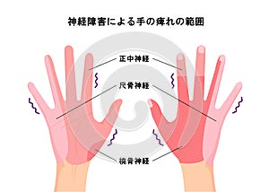 Range of hand numbness due to neurological disorders