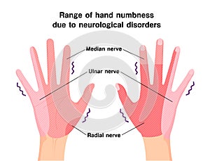 Range of hand numbness due to neurological disorders