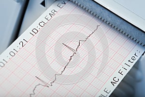 Rapid diagnosis of cardiac rhythm disorders. Macro photo