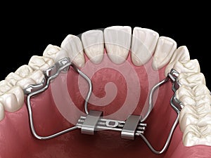Rapid Palatal Expansion. Medically accurate tooth 3D illustration
