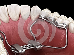 Rapid Palatal Expansion. Medically accurate tooth 3D illustration