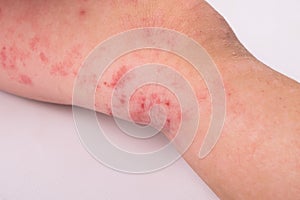 Rash on a child leg  on white background, redness, allergic reaction, dermatitis symptom