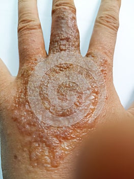 rash eczema dermatitis on finger hand. inflammation of skin