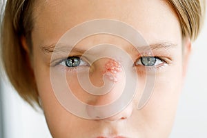 Rash on the face of a child, on the nose and eye, close-up: herpes, virus, infection, conjunctivitis, allergy - medical concept