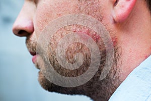 Rash reaction from drug or food allergy on face of caucasian man