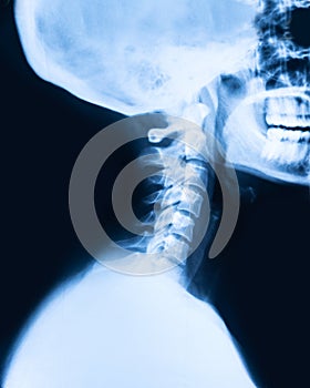 Ray x imaging of the cervical spine