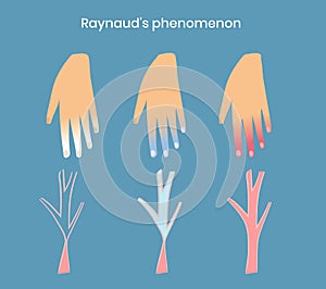 Raynaud`s disease and syndrome