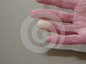 Raynaud's Syndrome Phenomenon hand pain circulatory neurological rheumatic cold skin medical male female Raynaud's photo