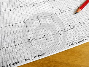 Reading medical ECG chart