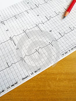 Reading medical ECG chart