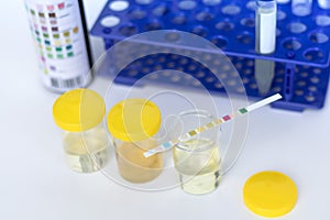 Reagent Strip for Urinalysis, Routine Urinalysis, urine test analysis in laboratory. Urine sample test.