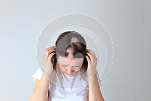 Real alopecia areata in a young girl. A bald head in a person.