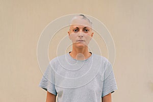 Real alopecia areata in a young girl. A bald head in a person. Diffuse alopecia