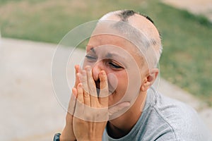 Real alopecia areata in a young girl. A bald head in a person. Diffuse alopecia