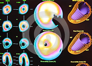 myocardial ischemia nuclear medicine photo