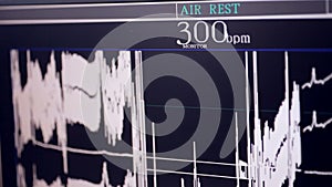 Real Cardiogram. Working cardiograph in a cardiology hospital.