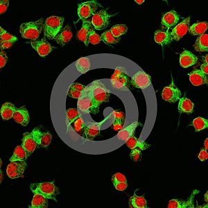 Real fluorescence microscopic view of human neuroblastoma cells