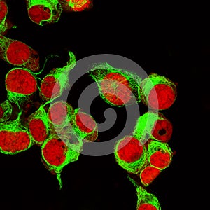 Real fluorescence microscopic view of human neuroblastoma cells