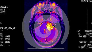 Real life man brain mri scan with tumor neoplasm medical reseach new quality health science 4k footage stock animation