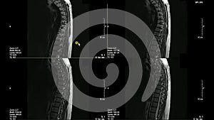 Real MRI Scan of Doctor examining the thoracic spine