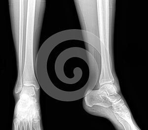 Real x-rays of the healthy lower leg - front and side view