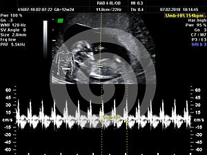real ultrasound diagnosis of a pregnant woman, duration: 12 week