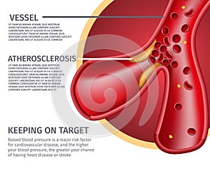 Realistic Atherosclerotic Vessels Anatomy Banner