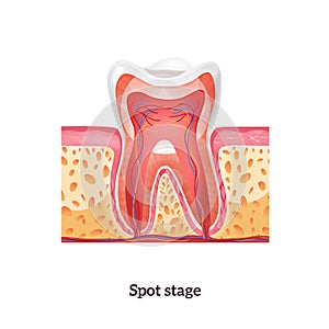 Realistic Caries Tooth Anatomy