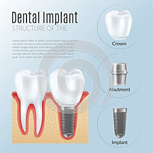 Realistic Dental Implant Infographics