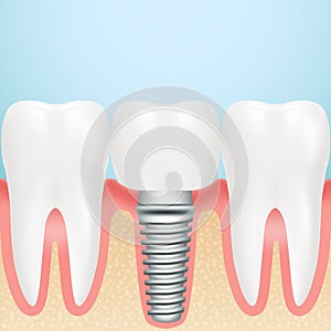 Realistic Dental Implant. Installation Of Dental Implant With All Parts Crown, Abutment, On A Background