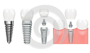 Realistic dental implant structure with all parts crown, abutment, screw. Dentistry. Implantation of human teeth. Vector