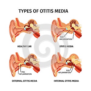 Realistic Ear Otitis Set