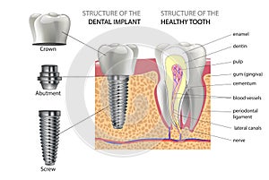 Realistic healthy tooth and structure, dental implant with all parts: crown, abutment, screw.