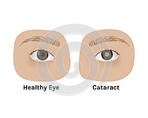 Realistic human healthy eye and with cataract vector illustration design.