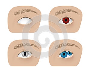 Realistic human healthy eye and with cataract vector illustration design.