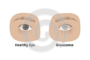 Realistic human healthy eye and with glaucoma vector illustration design