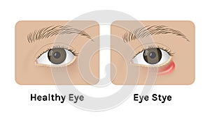 Realistic human healthy eye and with stye